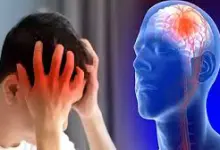 السكتة الدماغية، وكيفية تجنب حدوثها! 5 stroke